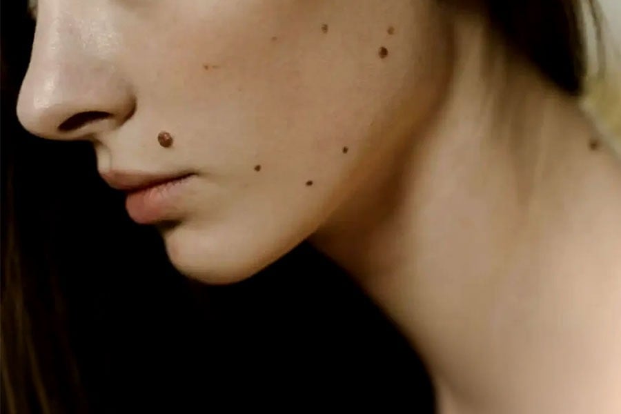 ছোট্ট তিলেই লুকিয়ে ক্যানসার বীজ? লক্ষণ চিনে সতর্ক থাকার পরামর্শ চিকিৎসকের